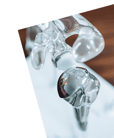 Anatomische Schulterprothese mit Kugelkopf am Oberarmknochen und Pfannenimplantat im Schultergelenkmodell