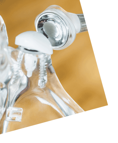 Inverse Schulterprothese mit Glenosphäre an der Schulterpfanne und Schaftimplantat im Oberarm bei Schultergelenkmodell